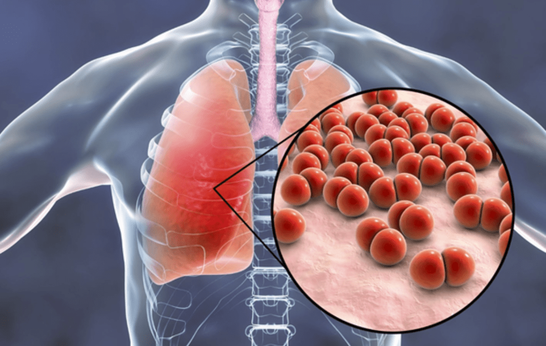 бактериальная пневмония